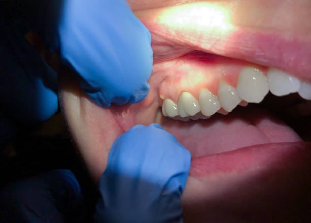 Best Root Canal Emergency Dentist  in Woodstock, AL